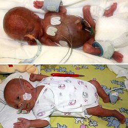 Sobrevive un bebé que pesó 275 gramos al nacer en la semana 25 de gestación en Alemania